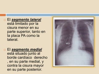  El segmento lateral
está limitado por la
cisura menor en su
parte superior, tanto en
la placa PA como la
lateral.
 El segmento medial
está situado junto al
borde cardíaco derecho
, en su parte medial, y
contra la cisura mayor
en su parte posterior.
 