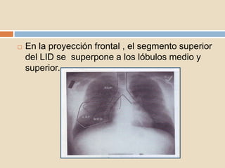  En la proyección frontal , el segmento superior
del LID se superpone a los lóbulos medio y
superior.
 