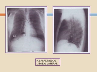 H.BASAL MEDIAL
I. BASAL LATERAL
 
