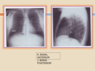 K. BASAL
ANTERIOR
J. BASAL
POSTERIOR
 
