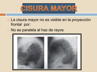  La cisura mayor no es visible en la proyección
frontal por:
 No es paralela al haz de rayos
 