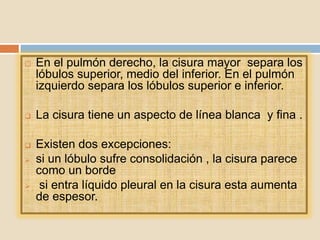  En el pulmón derecho, la cisura mayor separa los
lóbulos superior, medio del inferior. En el pulmón
izquierdo separa los lóbulos superior e inferior.
 La cisura tiene un aspecto de línea blanca y fina .
 Existen dos excepciones:
 si un lóbulo sufre consolidación , la cisura parece
como un borde
 si entra líquido pleural en la cisura esta aumenta
de espesor.
 