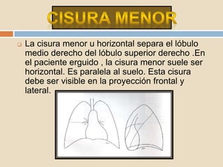  La cisura menor u horizontal separa el lóbulo
medio derecho del lóbulo superior derecho .En
el paciente erguido , la cisura menor suele ser
horizontal. Es paralela al suelo. Esta cisura
debe ser visible en la proyección frontal y
lateral.
 