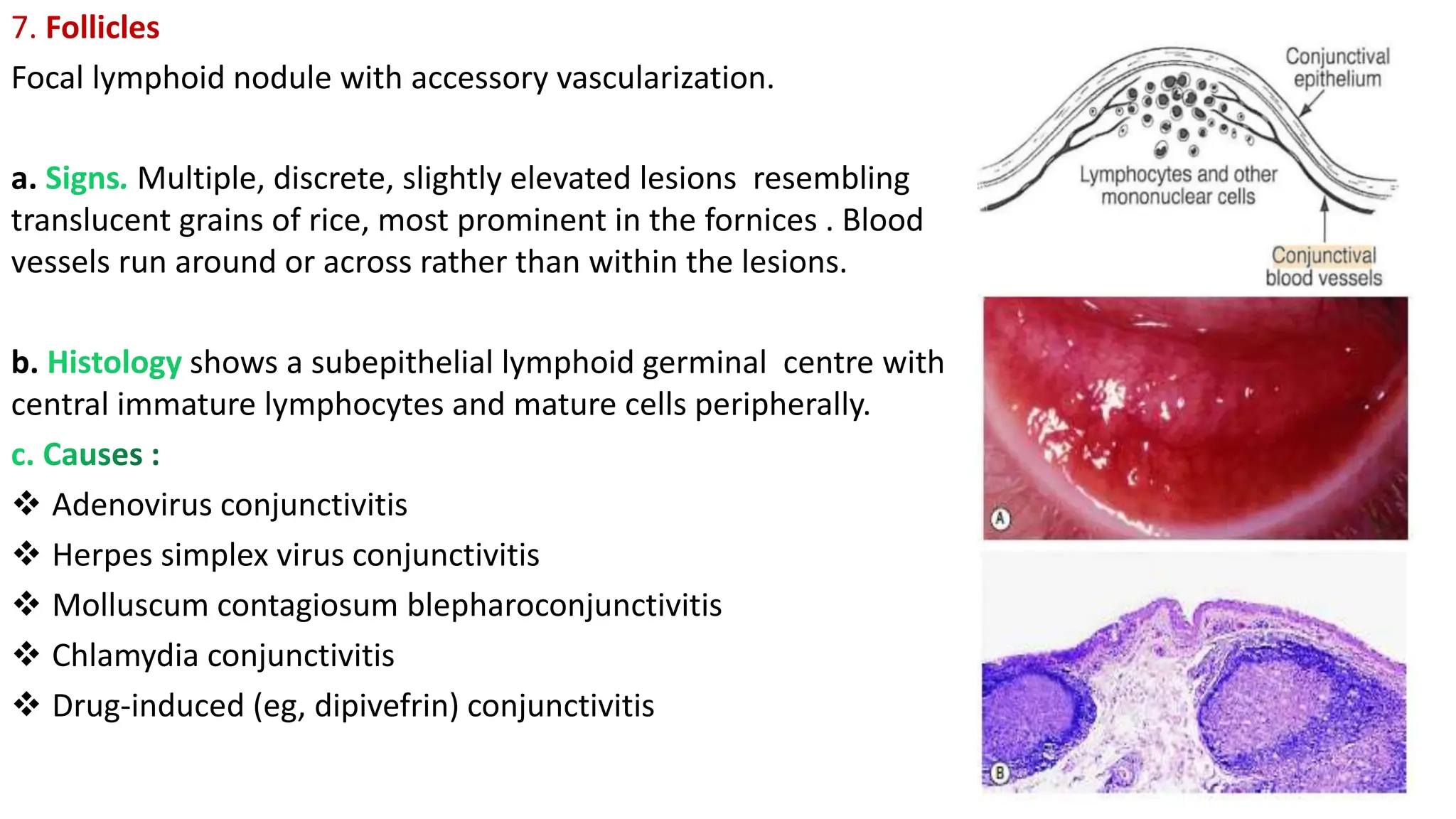 7. Follicles
Focal lymphoid nodule with accessory vascularization.
a. Multiple, discrete, slightly elevated lesions resembling
translucent grains of rice, most prominent in the fornices . Blood
vessels run around or across rather than within the lesions.
b. shows a subepithelial lymphoid germinal centre with
central immature lymphocytes and mature cells peripherally.
 Adenovirus conjunctivitis
 Herpes simplex virus conjunctivitis
 Molluscum contagiosum blepharoconjunctivitis
 Chlamydia conjunctivitis
 Drug-induced (eg, dipivefrin) conjunctivitis
 