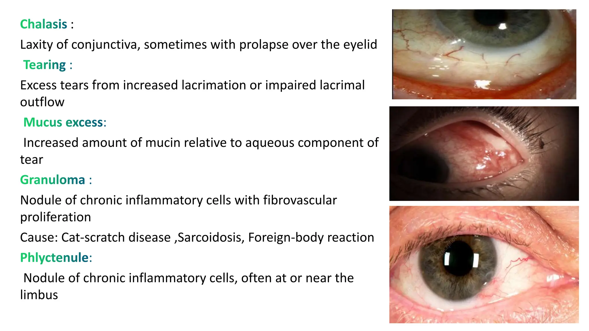 :
Laxity of conjunctiva, sometimes with prolapse over the eyelid
Excess tears from increased lacrimation or impaired lacrimal
outflow
Increased amount of mucin relative to aqueous component of
tear
Nodule of chronic inflammatory cells with fibrovascular
proliferation
Cause: Cat-scratch disease ,Sarcoidosis, Foreign-body reaction
Nodule of chronic inflammatory cells, often at or near the
limbus
 