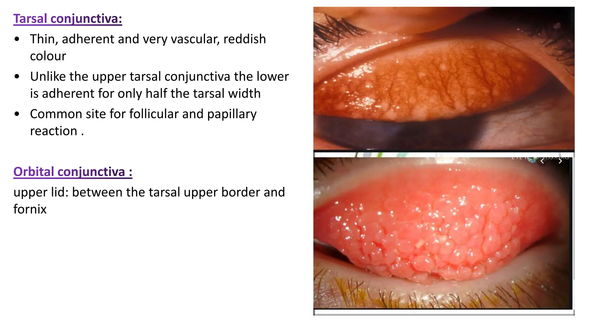 • Thin, adherent and very vascular, reddish
colour
• Unlike the upper tarsal conjunctiva the lower
is adherent for only half the tarsal width
• Common site for follicular and papillary
reaction .
upper lid: between the tarsal upper border and
fornix
 