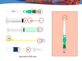 Key sites in CVC care
 