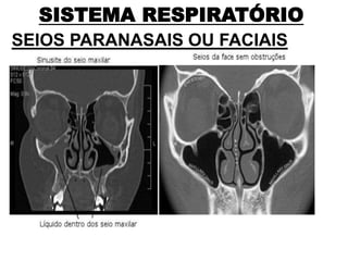 SISTEMA RESPIRATÓRIO
SEIOS PARANASAIS OU FACIAIS
 