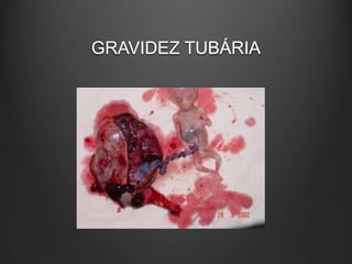 GRAVIDEZ TUBÁRIA
 