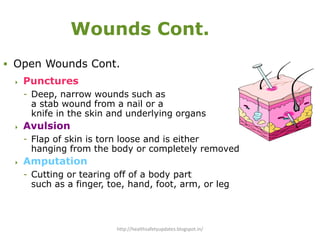 Wounds Cont.
 Open Wounds Cont.
 Punctures
- Deep, narrow wounds such as
a stab wound from a nail or a
knife in the skin and underlying organs
 Avulsion
- Flap of skin is torn loose and is either
hanging from the body or completely removed
 Amputation
- Cutting or tearing off of a body part
such as a finger, toe, hand, foot, arm, or leg
http://healthsafetyupdates.blogspot.in/
 