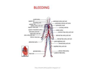 BLEEDING
http://healthsafetyupdates.blogspot.in/
 