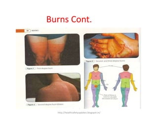 Burns Cont.
http://healthsafetyupdates.blogspot.in/
 