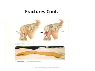 Fractures Cont.
http://healthsafetyupdates.blogspot.in/
 