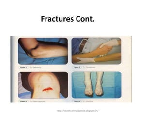 Fractures Cont.
http://healthsafetyupdates.blogspot.in/
 