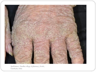 Apollojames, Nandha college of pharmacy, Erode,
Tamilnadu, India
 