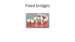 Fixed bridges
 
