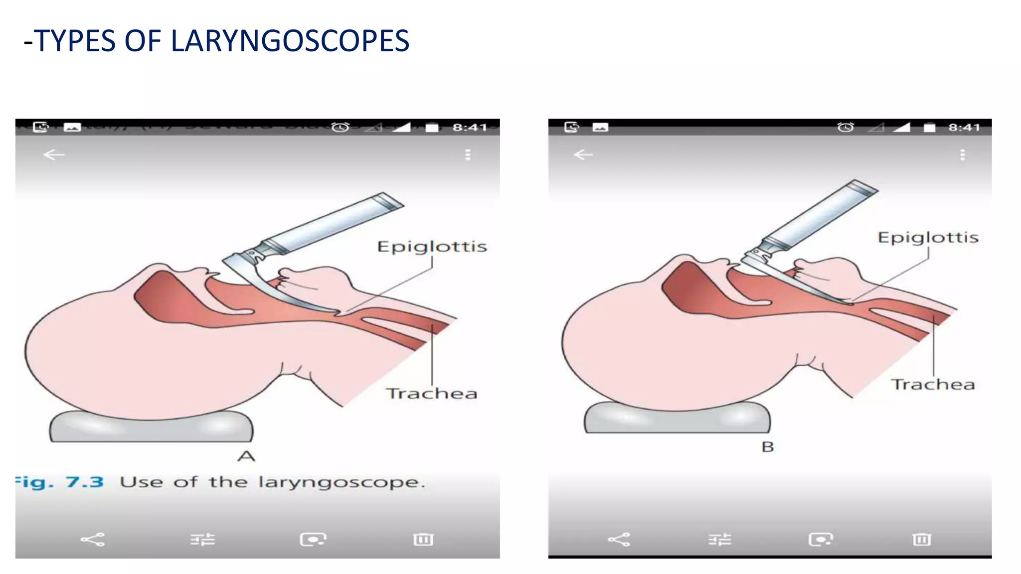 endotracheal intubation and laryngoscopy part-2-Anesthesia | PDF