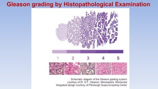 Modified Gleason 5 Basics of Prostate Cancer.pptx