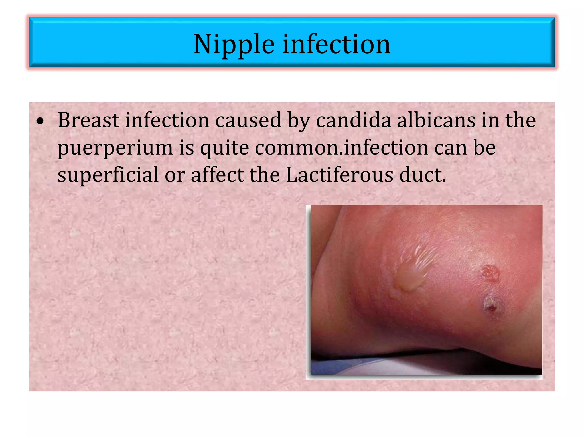 Breast Complications | PPTX