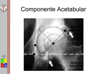 Planificación Preoperatoria de PTC | PPTX