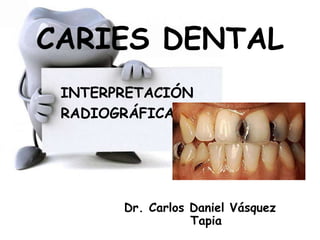 CARIES DENTAL
INTERPRETACIÓN
RADIOGRÁFICA
Dr. Carlos Daniel Vásquez
Tapia
 