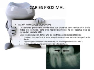 CARIES PROXIMAL
• LESIÓN PROXIMALES MODERADAS
• Las lesiones proximales moderadas son aquellas que afectan más de la
mitad del esmalte, pero que radiológicamente no se observa que se
extiendan hasta la UED.
• Estas lesiones suelen tener uno de los tres aspectos radiológicos:
o Primera y más común 67%, es un triángulo como su base ancha en la superficie del
diente.
o Segunda y mucho menos frecuente 16%, es una imagen radiolúcida difusa.
o Tercera un 17%, es una combinación de estos dos tipos.
 