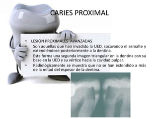 CARIES PROXIMAL
• LESIÓN PROXIMALES AVANZADAS
• Son aquellas que han invadido la UED, socavando el esmalte y
extendiéndose posteriormente a la dentina.
• Esta forma una segunda imagen triangular en la dentina con su
base en la UED y su vértice hacia la cavidad pulpar.
• Radiológicamente se muestra que no se han extendido a más
de la mitad del espesor de la dentina.
 
