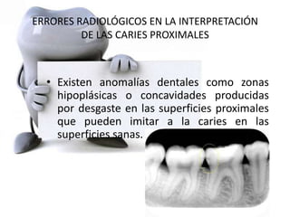 ERRORES RADIOLÓGICOS EN LA INTERPRETACIÓN
DE LAS CARIES PROXIMALES
• Existen anomalías dentales como zonas
hipoplásicas o concavidades producidas
por desgaste en las superficies proximales
que pueden imitar a la caries en las
superficies sanas.
 