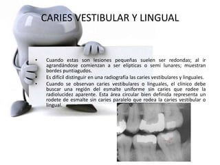 CARIES VESTIBULAR Y LINGUAL
• Cuando estas son lesiones pequeñas suelen ser redondas; al ir
agrandándose comienzan a ser elípticas o semi lunares; muestran
bordes puntiagudos.
• Es difícil distinguir en una radiografía las caries vestibulares y linguales.
• Cuando se observan caries vestibulares o linguales, el clínico debe
buscar una región del esmalte uniforme sin caries que rodee la
radiolucidez aparente. Esta área circular bien definida representa un
rodete de esmalte sin caries paralelo que rodea la caries vestibular o
lingual.
 