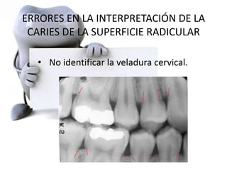 ERRORES EN LA INTERPRETACIÓN DE LA
CARIES DE LA SUPERFICIE RADICULAR
• No identificar la veladura cervical.
 