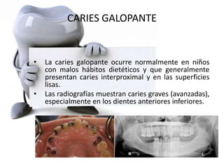 CARIES GALOPANTE
• La caries galopante ocurre normalmente en niños
con malos hábitos dietéticos y que generalmente
presentan caries interproximal y en las superficies
lisas.
• Las radiografías muestran caries graves (avanzadas),
especialmente en los dientes anteriores inferiores.
 