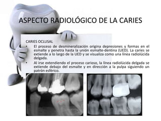 ASPECTO RADIOLÓGICO DE LA CARIES
CARIES OCLUSAL
• El proceso de desmineralización origina depresiones y formas en el
esmalte y penetra hasta la unión esmalte-dentina (UED). La caries se
extiende a lo largo de la UED y se visualiza como una línea radiolúcida
delgada.
• Al irse extendiendo el proceso carioso, la línea radiolúcida delgada se
extiende debajo del esmalte y en dirección a la pulpa siguiendo un
patrón esférico.
 