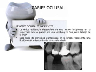 CARIES OCLUSAL
LESIONES OCLUSALES INCIPIENTES
• La única evidencia detectable de una lesión incipiente en la
superficie oclusal puede ser una sombra gris fina justo debajo de
la UED.
• Esta línea de densidad aumentada en la unión representa una
ilusión óptica denominada banda de Mach.
 