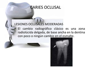 CARIES OCLUSAL
LESIONES OCLUSALES MODERADAS
• El cambio radiográfico clásico es una zona
radiolúcida delgada, de base ancha en la dentina
con poco o ningún cambio en el esmalte.
 