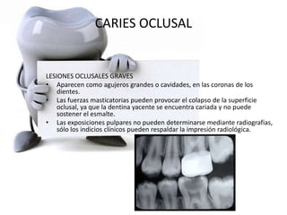 CARIES OCLUSAL
LESIONES OCLUSALES GRAVES
• Aparecen como agujeros grandes o cavidades, en las coronas de los
dientes.
• Las fuerzas masticatorias pueden provocar el colapso de la superficie
oclusal, ya que la dentina yacente se encuentra cariada y no puede
sostener el esmalte.
• Las exposiciones pulpares no pueden determinarse mediante radiografías,
sólo los indicios clínicos pueden respaldar la impresión radiológica.
 