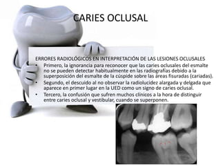 CARIES OCLUSAL
ERRORES RADIOLÓGICOS EN INTERPRETACIÓN DE LAS LESIONES OCLUSALES
• Primero, la ignorancia para reconocer que las caries oclusales del esmalte
no se pueden detectar habitualmente en las radiografías debido a la
superposición del esmalte de la cúspide sobre las áreas fisuradas (cariadas).
• Segundo, el descuido al no observar la radiolucidez alargada y delgada que
aparece en primer lugar en la UED como un signo de caries oclusal.
• Tercero, la confusión que sufren muchos clínicos a la hora de distinguir
entre caries oclusal y vestibular, cuando se superponen.
 