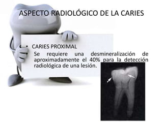 ASPECTO RADIOLÓGICO DE LA CARIES
• CARIES PROXIMAL
• Se requiere una desmineralización de
aproximadamente el 40% para la detección
radiológica de una lesión.
 