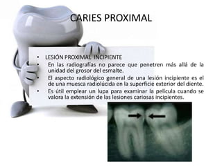 CARIES PROXIMAL
• LESIÓN PROXIMAL INCIPIENTE
• En las radiografías no parece que penetren más allá de la
unidad del grosor del esmalte.
• El aspecto radiológico general de una lesión incipiente es el
de una muesca radiolúcida en la superficie exterior del diente.
• Es útil emplear un lupa para examinar la película cuando se
valora la extensión de las lesiones cariosas incipientes.
 