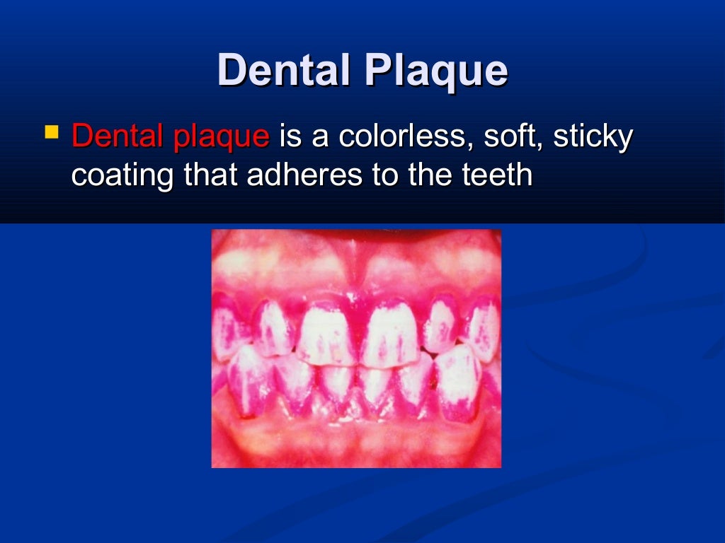 caries prevention i