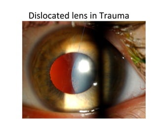 Dislocated lens in Trauma
 