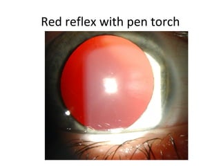Red reflex with pen torch
 