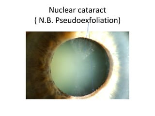 Nuclear cataract
( N.B. Pseudoexfoliation)
 