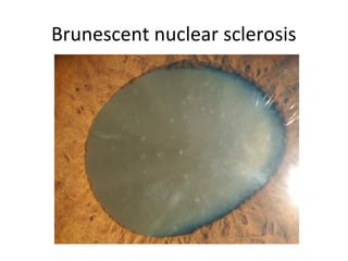 Brunescent nuclear sclerosis
 