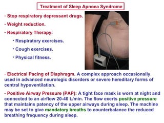 Treatment of Sleep Apnoea Syndrome
- Stop respiratory depressant drugs.
- Weight reduction.
- Respiratory Therapy:
• Respiratory exercises.
• Cough exercises.
• Physical fitness.
- Electrical Pacing of Diaphragm. A complex approach occasionally
used in advanced neurologic disorders or severe hereditary forms of
central hypoventilation.
- Positive Airway Pressure (PAP): A tight face mask is worn at night and
connected to an airflow 20-40 L/min. The flow exerts positive pressure
that maintains patency of the upper airways during sleep. The machine
may be set to give mandatory breaths to counterbalance the reduced
breathing frequency during sleep.
 