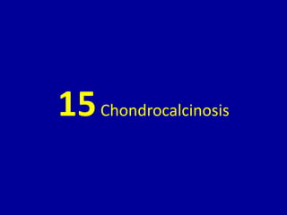 15Chondrocalcinosis
 