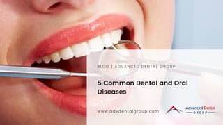 5 Common Dental and Oral
Diseases
BLOG | ADVANCED DENTAL GROUP
www.advdentalgroup.com
 
