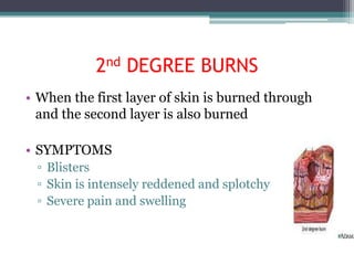 2nd DEGREE BURNS
• When the first layer of skin is burned through
  and the second layer is also burned

• SYMPTOMS
 ▫ Blisters
 ▫ Skin is intensely reddened and splotchy
 ▫ Severe pain and swelling
 