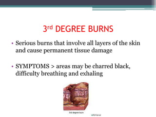 3rd DEGREE BURNS
• Serious burns that involve all layers of the skin
  and cause permanent tissue damage

• SYMPTOMS > areas may be charred black,
  difficulty breathing and exhaling
 