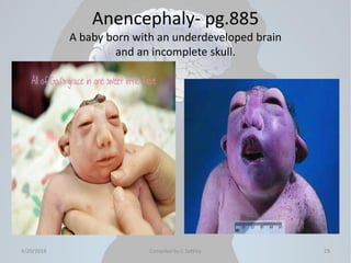 Brainless Child Congenital conditions | PDF