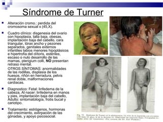 Síndrome de Turner
 Alteración cromo.: perdida del
cromosoma sexual x (45,X).
 Cuadro clínico: disgenesia del ovario
con hipoplasia, talla baja, obesas,
implantación baja del cabello, cara
triangular, tórax ancho y pezones
separados, genitales externos
infantiles labios menores hipoplásicos
e hipertrofia del clítoris, estériles,
escaso o nulo desarrollo de las
mamas, pterigium colli, NO presentan
retraso mental.
OTROS SÍNTOMAS: anormalidades
de las rodillas, displasia de los
huesos, riñón en herradura, pelvis
renal doble, malformaciones
cardiacas.
 Diagnostico: Fetal: linfedema de la
cabeza, Al nacer: linfedema en manos
y pies, implantación baja del cabello,
Adulto: sintomatología, frotis bucal y
cariotipo.
 Tratamiento: estrógenos, hormonas
del crecimiento, extirpación de las
gónadas, y apoyo psicosocial.
 